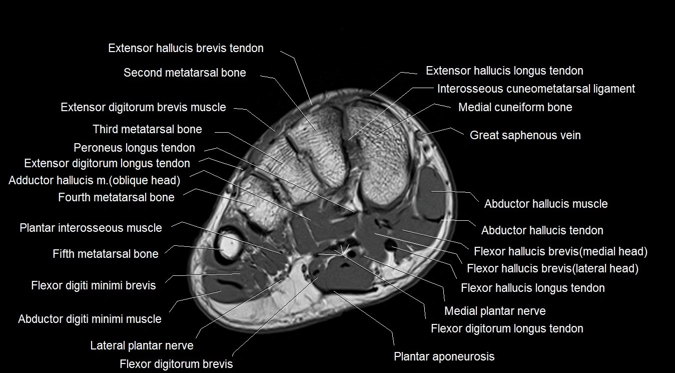MRI 3T foot axial cross sectional anatomy image 12.webp